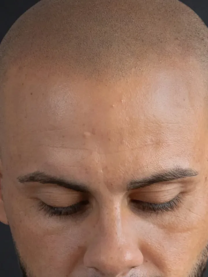 Nachher: Glatze von vorne, vor und nach der Haarpigmentierung