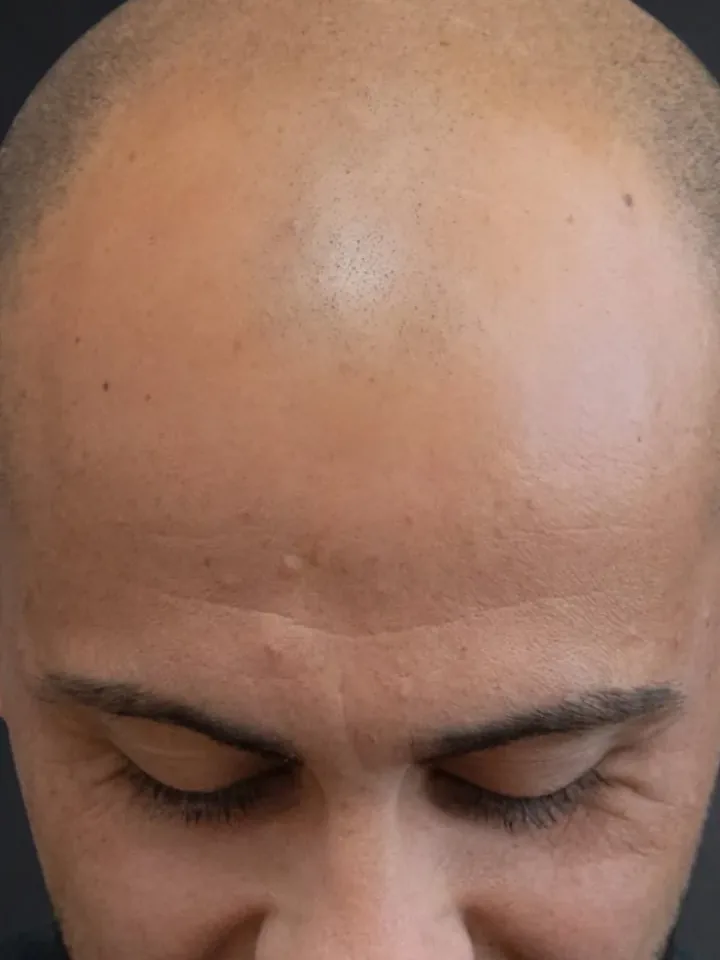 Vorher: Glatze von vorne, vor und nach der Haarpigmentierung