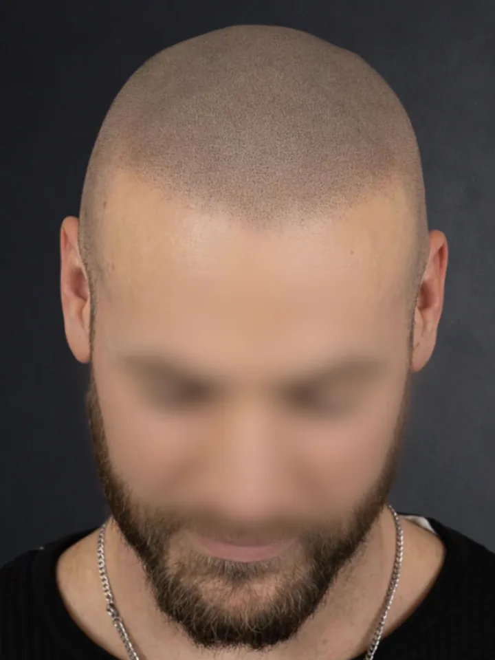 Nachher: lichter Haaransatz vor und nach der Haarpigmentierung