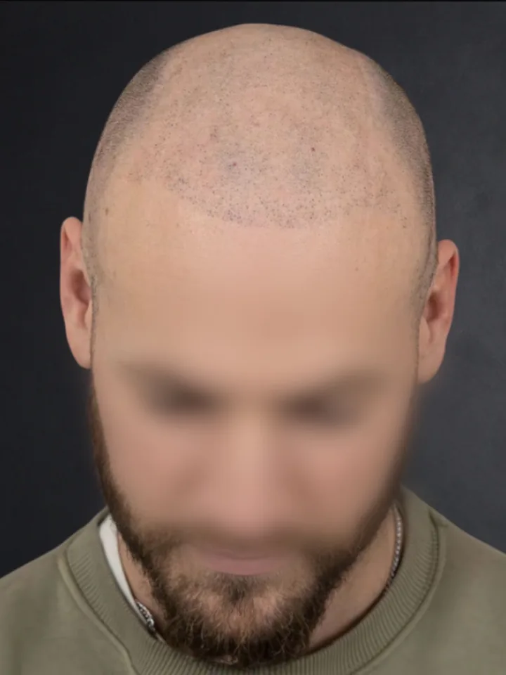 Vorher: lichter Haaransatz vor und nach der Haarpigmentierung