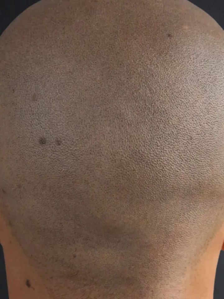 Nachher: Hinterkopf mit lichten Stellen vor und nach der Haarpigmentierung