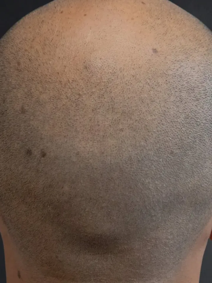 Vorher: Hinterkopf mit lichten Stellen vor und nach der Haarpigmentierung