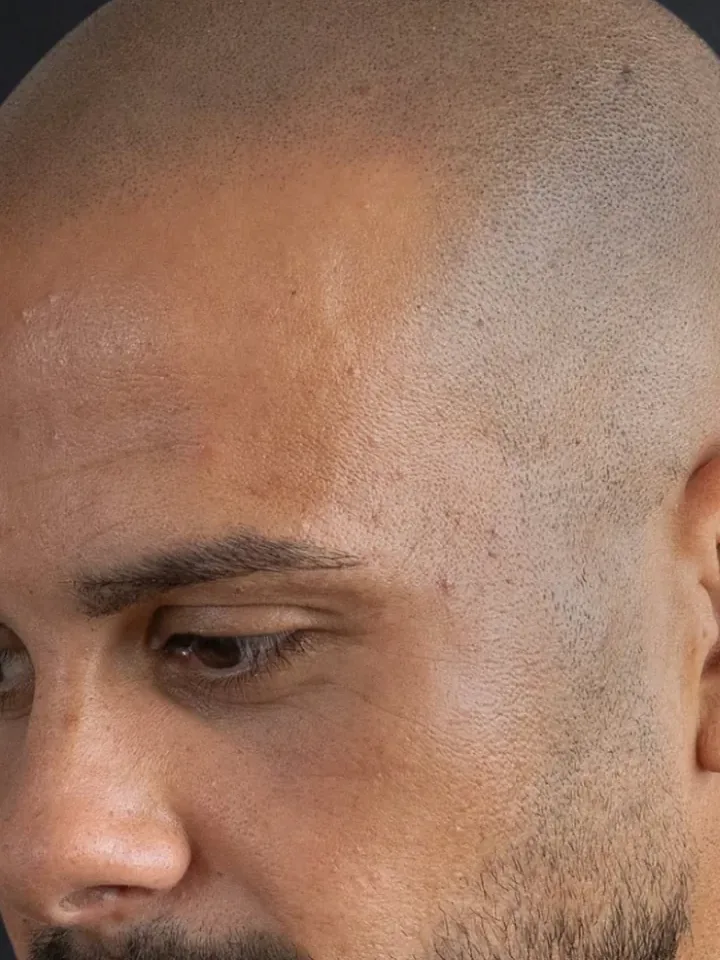 Nachher: Glatze von der Seite, vor und nach der Haarpigmentierung