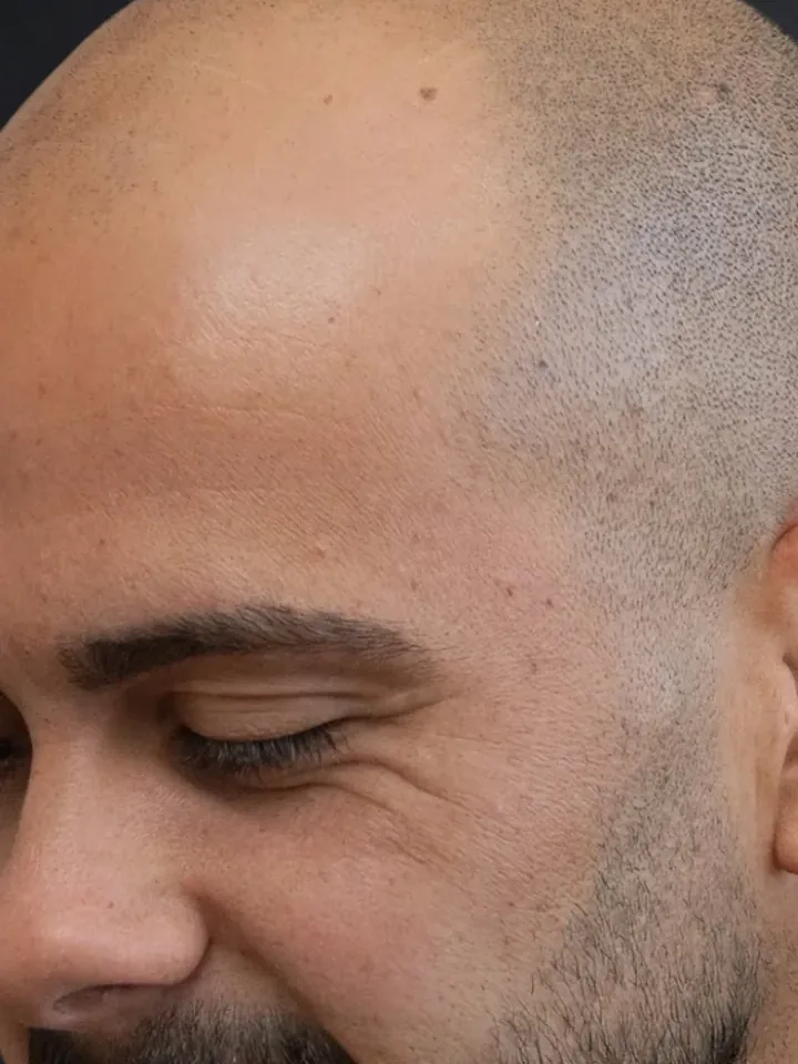 Vorher: Glatze von der Seite, vor und nach der Haarpigmentierung