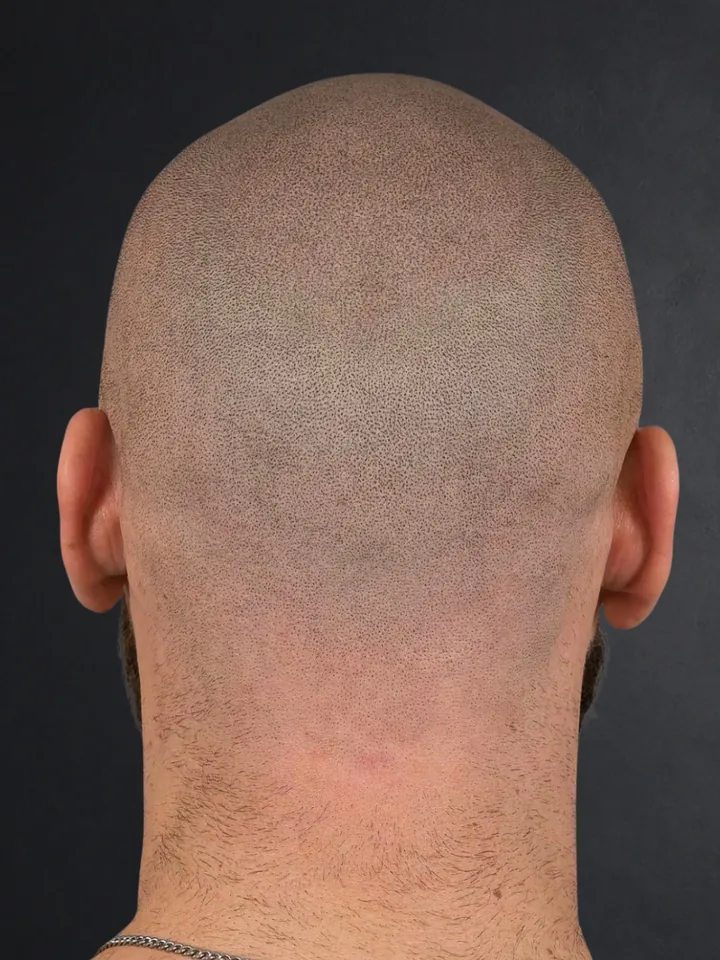 Nachher: Hinterkopf mit Tonsur vor und nach der Haarpigmentierung
