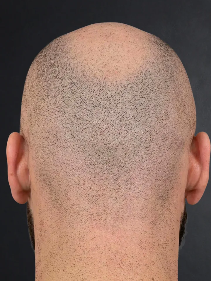 Vorher: Hinterkopf mit Tonsur vor und nach der Haarpigmentierung